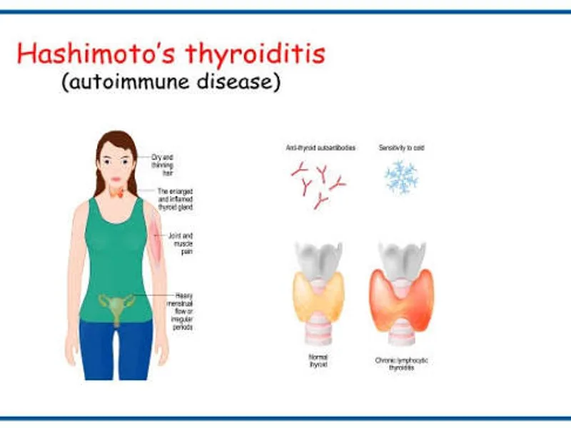 Hashimoto's Disease: Symptoms, Causes & Treatment Guide
