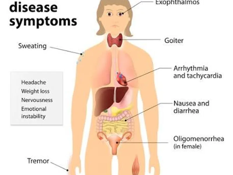 Graves' Disease: Symptoms, Causes & Treatment Guide