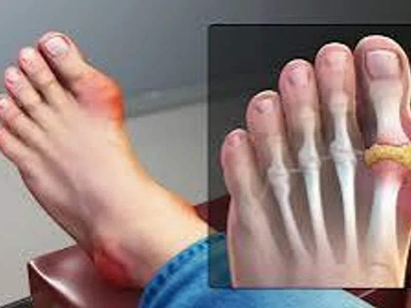 Gout Disease: Symptoms, Causes & Treatment Guide