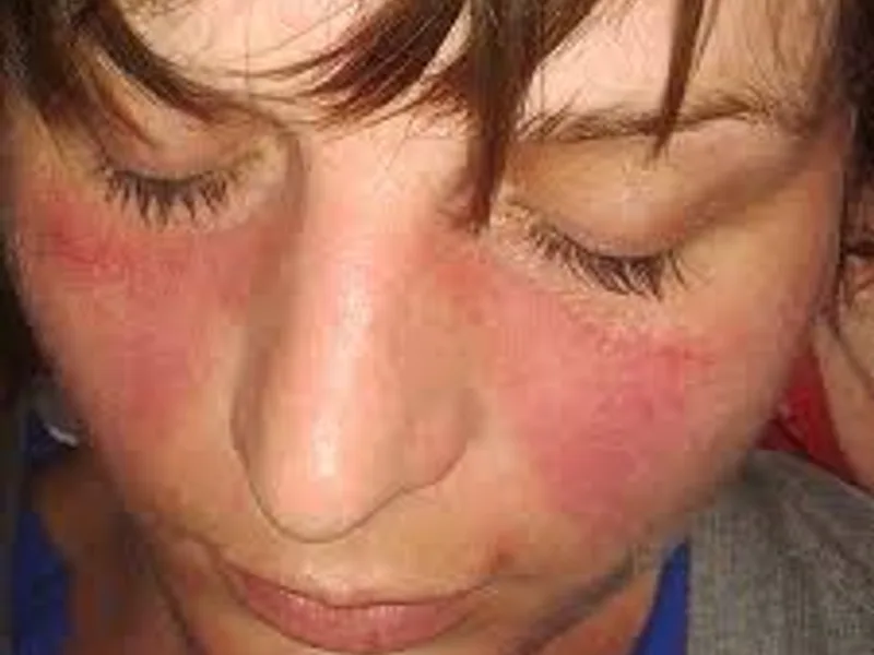Lupus Disease: Symptoms, Causes & Treatment Guide