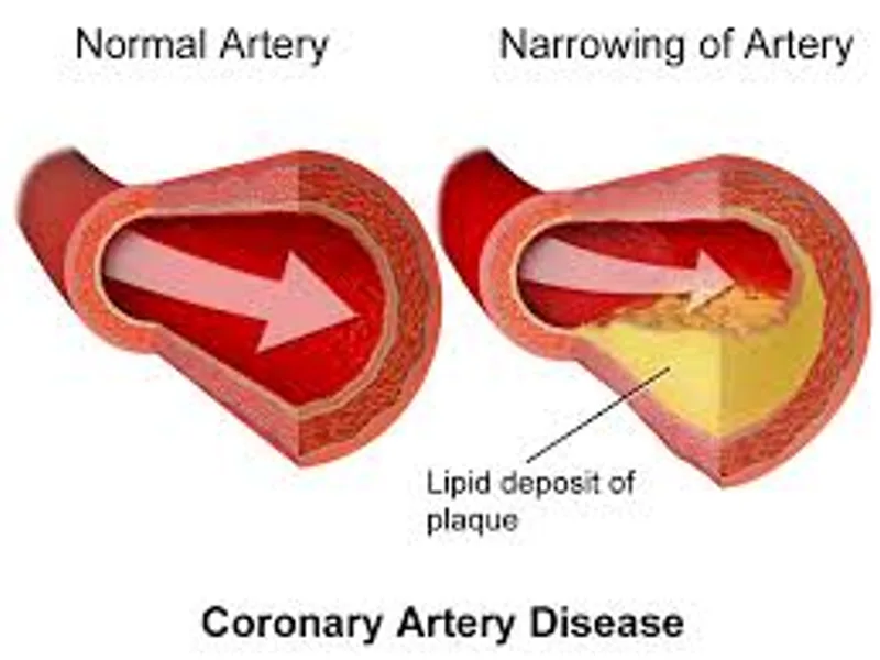 Coronary Heart Disease: Symptoms, Causes & Treatment Guide