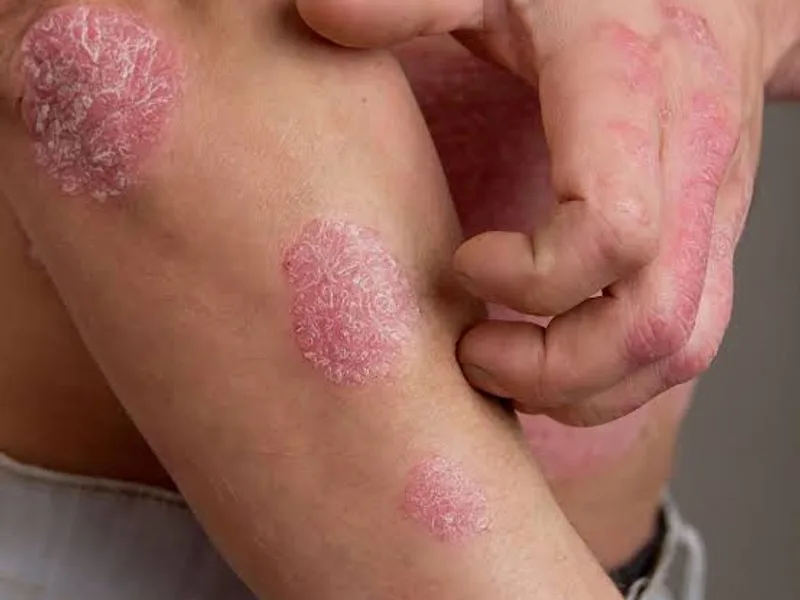 Psoriasis Disease: Symptoms, Causes & Treatment Guide