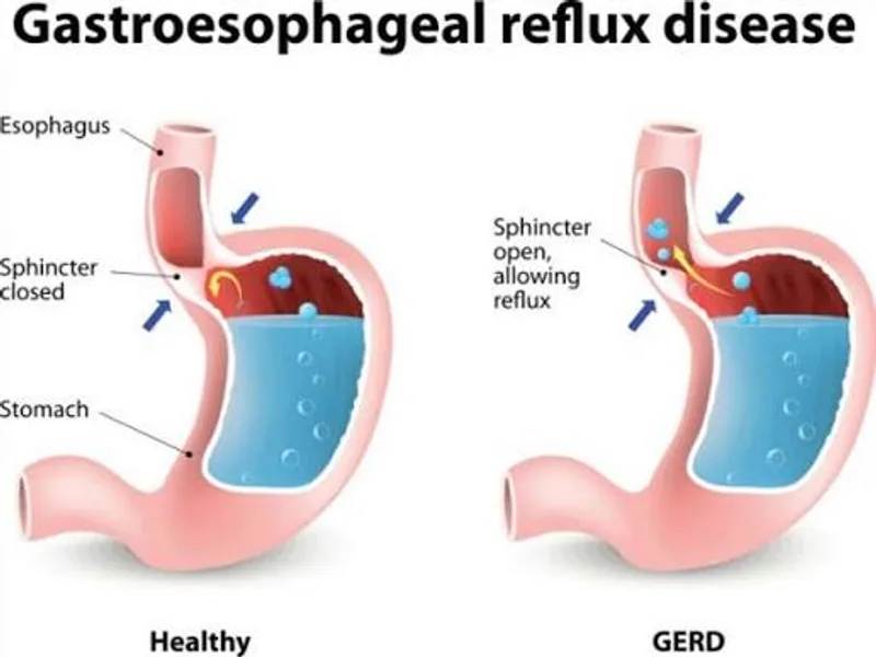 GERD Disease: Symptoms, Causes & Acid Reflux Treatment