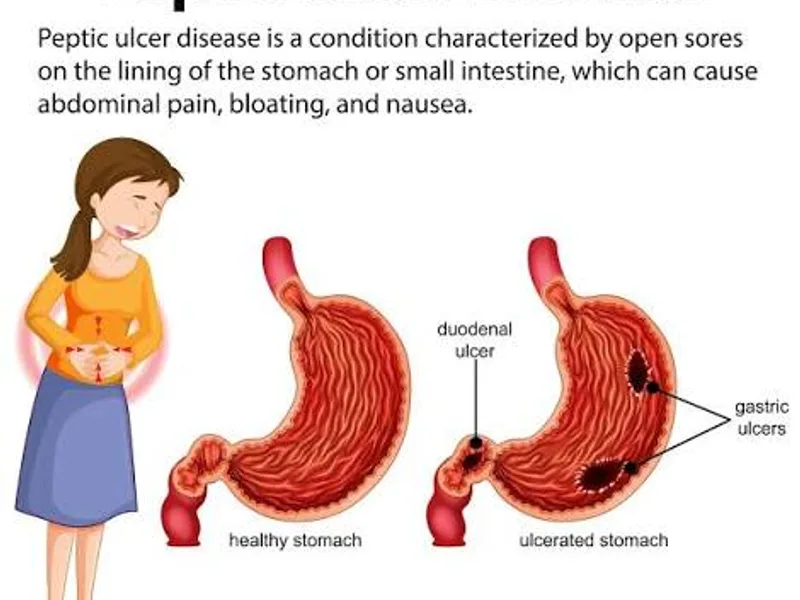 Peptic Ulcer Disease: Symptoms, Causes & Treatment Guide