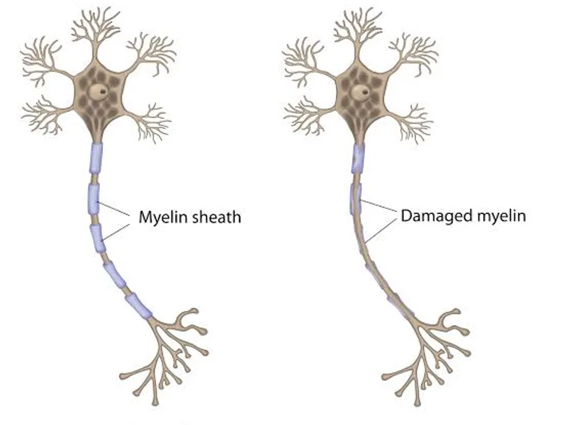 Multiple Sclerosis: Symptoms, Causes & Treatment Guide