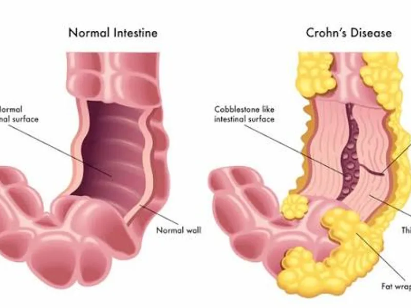 Crohn Disease: Symptoms, Causes & Treatment Guide