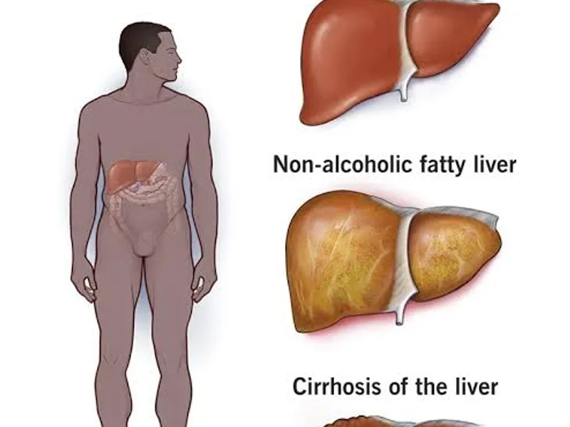 Liver Disease: Symptoms, Causes & Treatment Guide