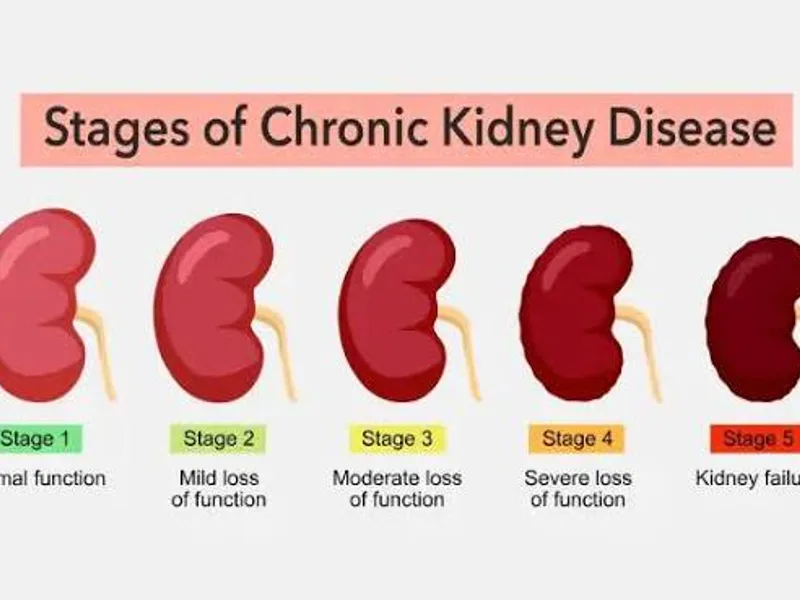 Chronic Kidney Disease: Symptoms, Causes & Treatment