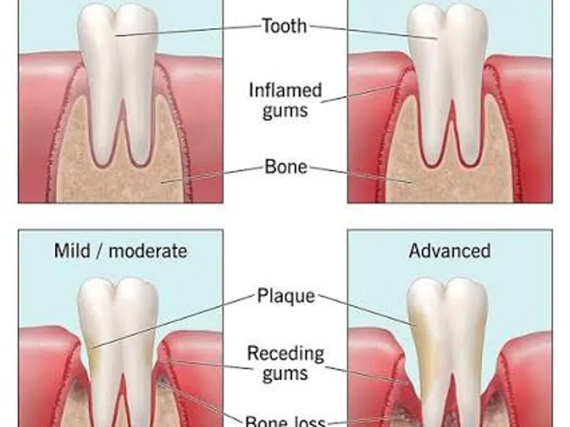 Gum Disease (Periodontal Disease): Causes, Stages, Treatment & Prevention