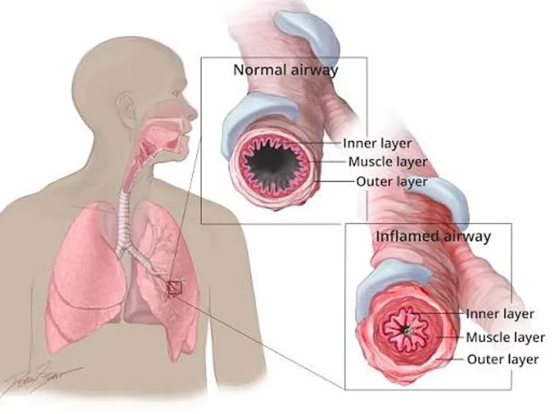 How Long Does Asthma Last? Attacks, Flares & Remission