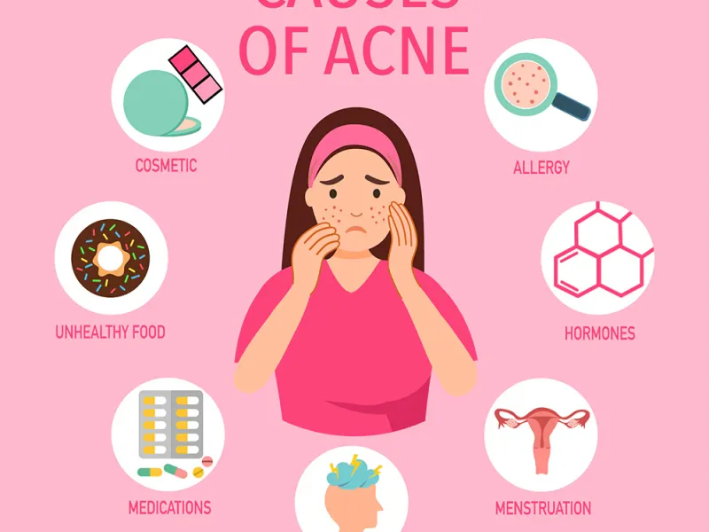 Causes of Acne: What Actually Triggers Breakouts
