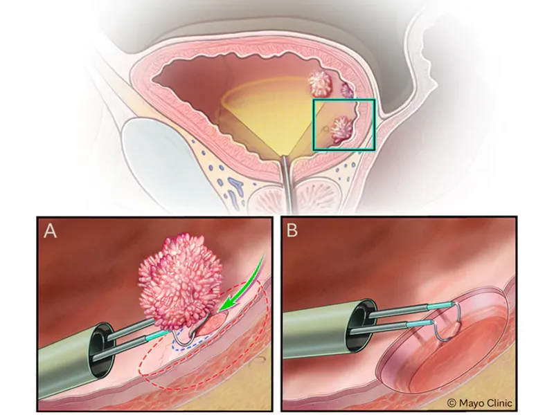 Mayo Study: Immunotherapy Spares Bladder Cancer Surgery