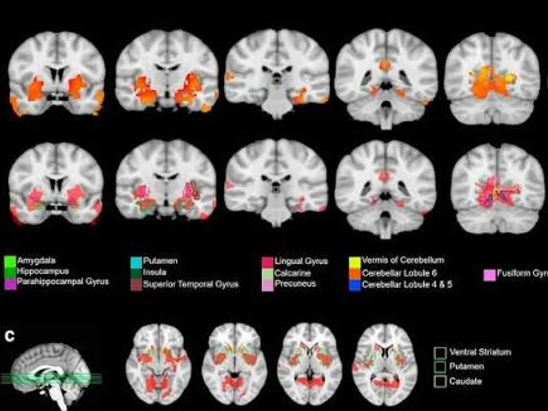 Adolescent Marijuana Brain Study: What Scans Show