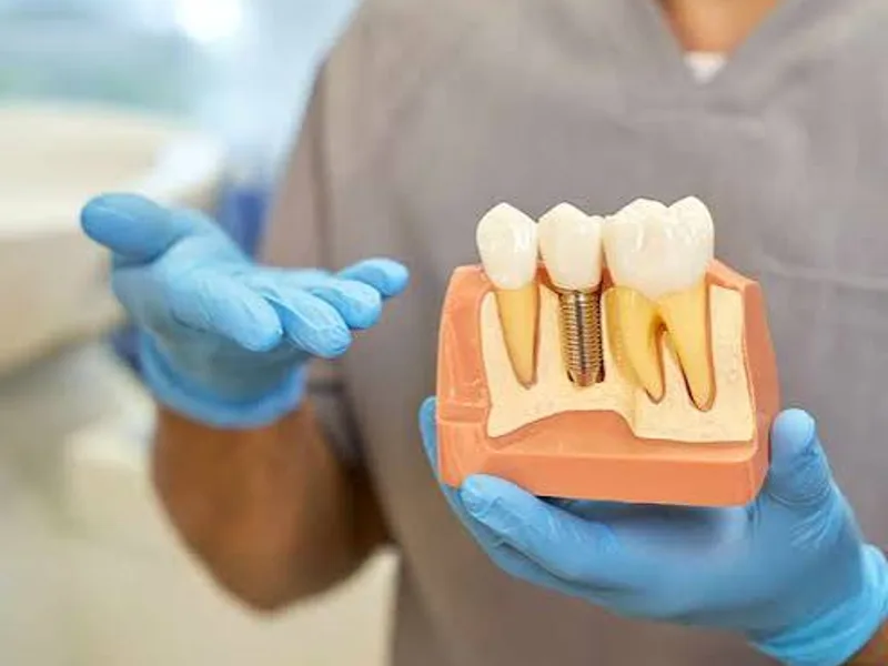 Dental Implants Near Me: What to Check Before You Book