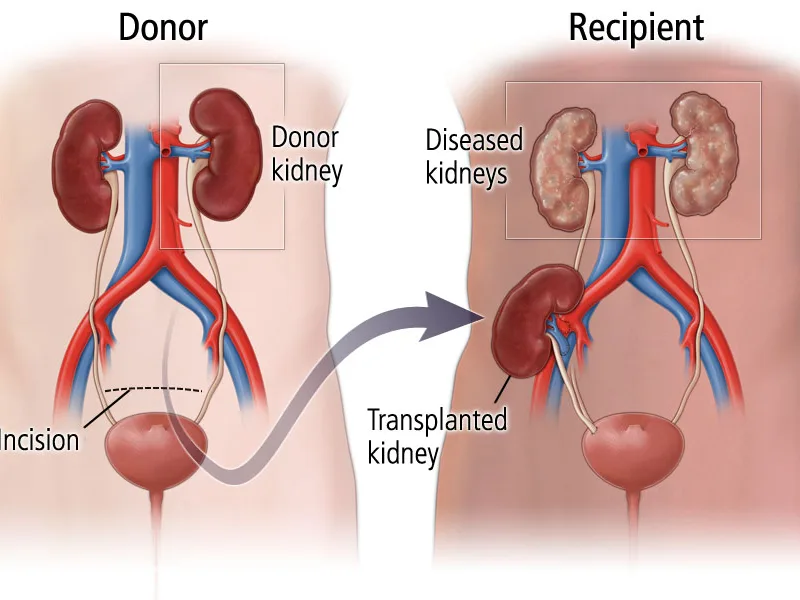 Living Donor Kidney Program: What to Know