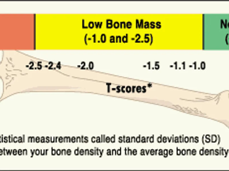 Osteoporosis and Bone Density: What to Know