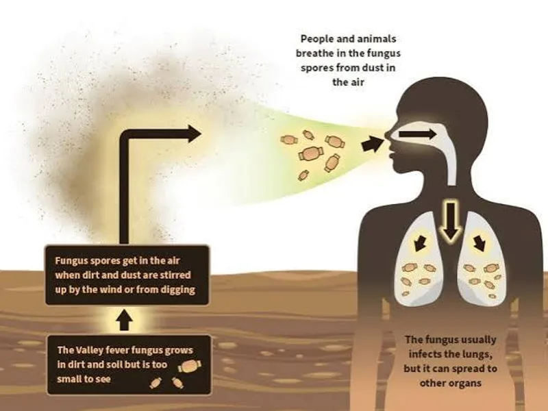 Valley Fever Record Cases Hit the West Coast in 2026