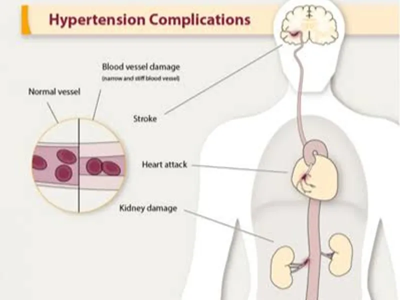 Hypertension and Alcohol: A Realistic Reduction Plan