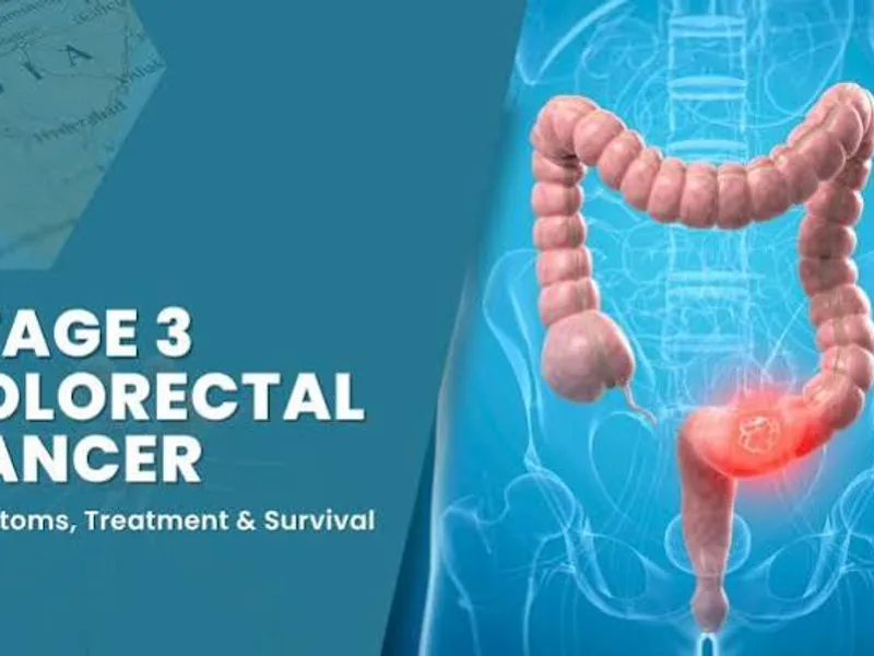 Stage 3B colon cancer age 32