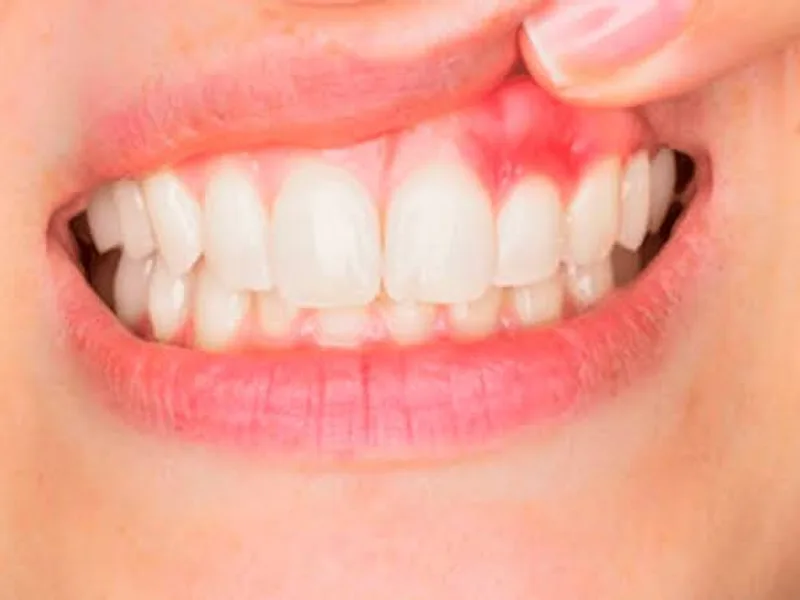 Signs of Gum Disease: What Every Deoghar Resident Should Know