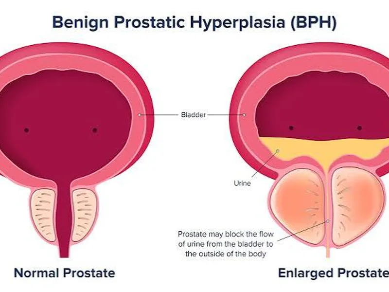 Prostate enlargement (BPH) symptoms