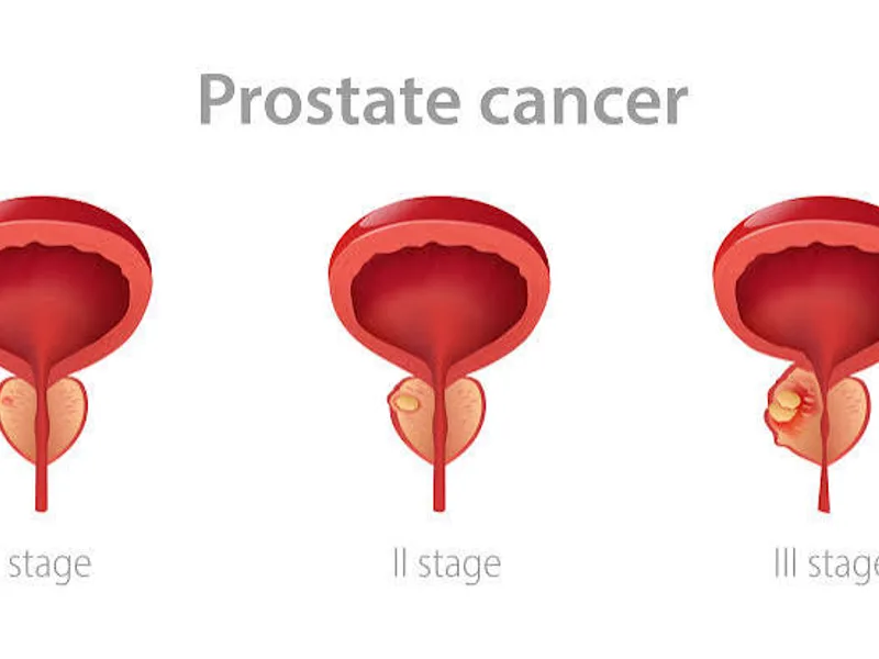 Prostate cancer screening (PSA test)
