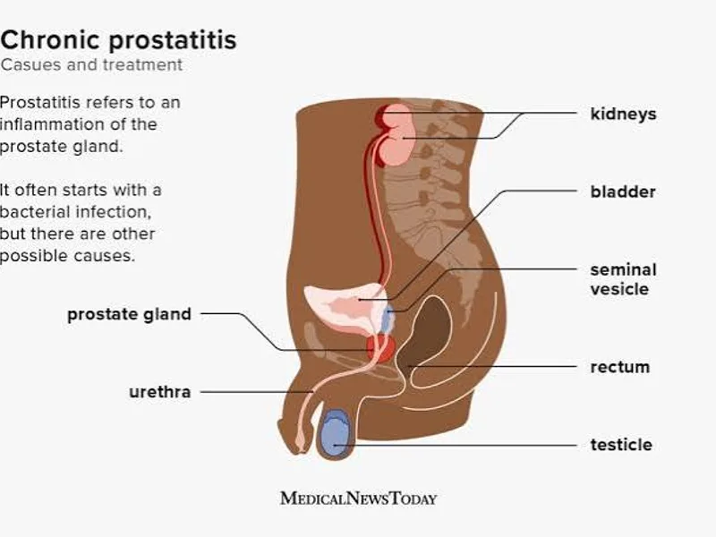 Prostatitis symptoms and treatment