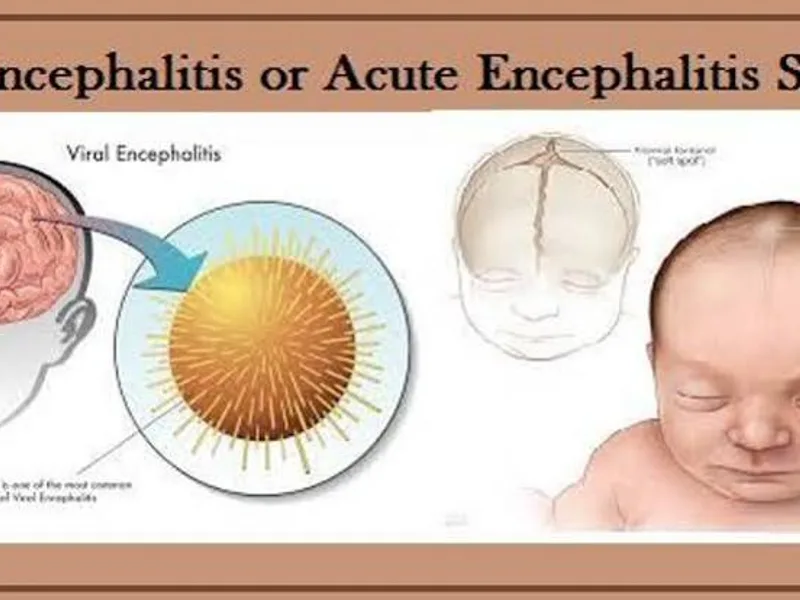 Chamki Bukhar (AES) in Muzaffarpur: Symptoms & Care