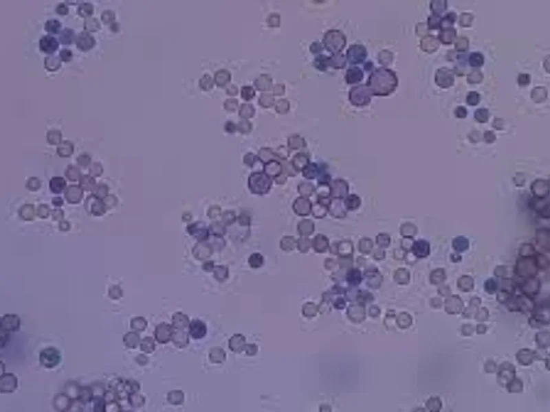 India Ink: A Vital Tool in Diagnosing Cryptococcus