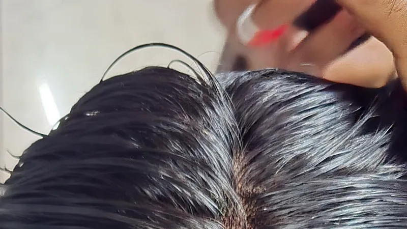 US hair clinic Ajmer