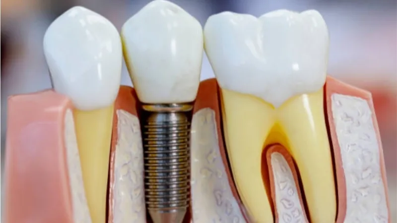 Dr Ravi Dental Clinic Best Dental Clinic in Ambattur ( k k road, Venkatapuram) Chennai Clinic