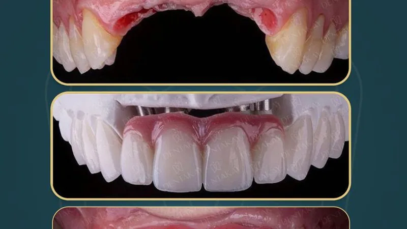 YASHASWI DENTAL CARE (DR JIGAR HAJARIWALA) SPECIALITY IN FULL MOUTH FIXED BRIDGES( SINCE 2006)