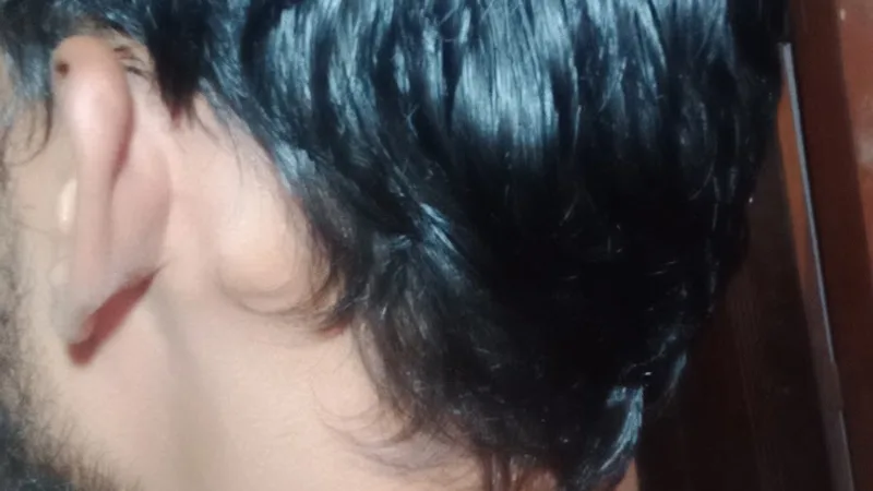 Zenith Clinic Kolkata Plastic Surgeon |Gynecomastia surgery | Rhinoplasty | Lipoma | transgender surgery | Liposuction