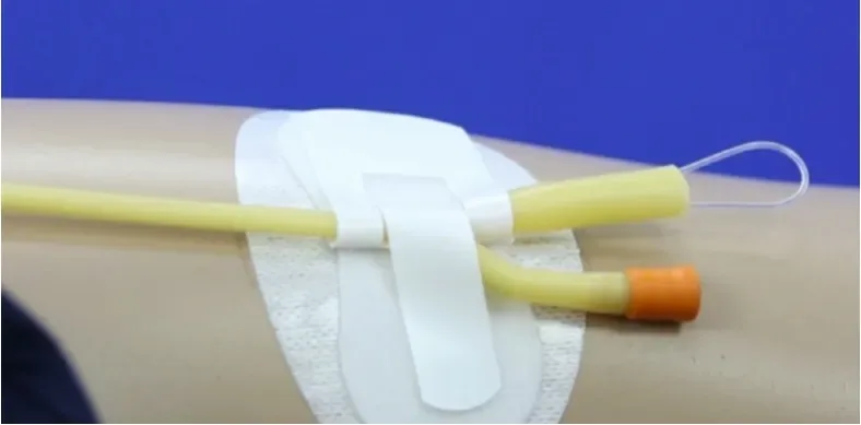 Velfix Secure- Foley Fixation Dressing- Similar To Fixocath And Statlock